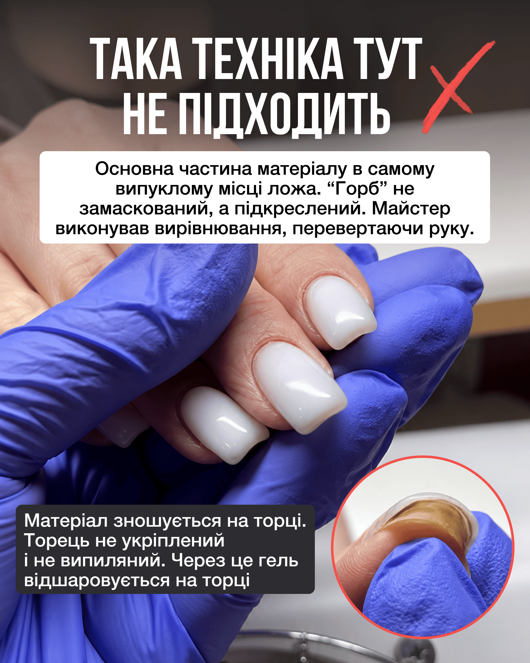 Неправильна техніка вирівнювання нігтів із перевантаженням ложа та відшаруванням на торці