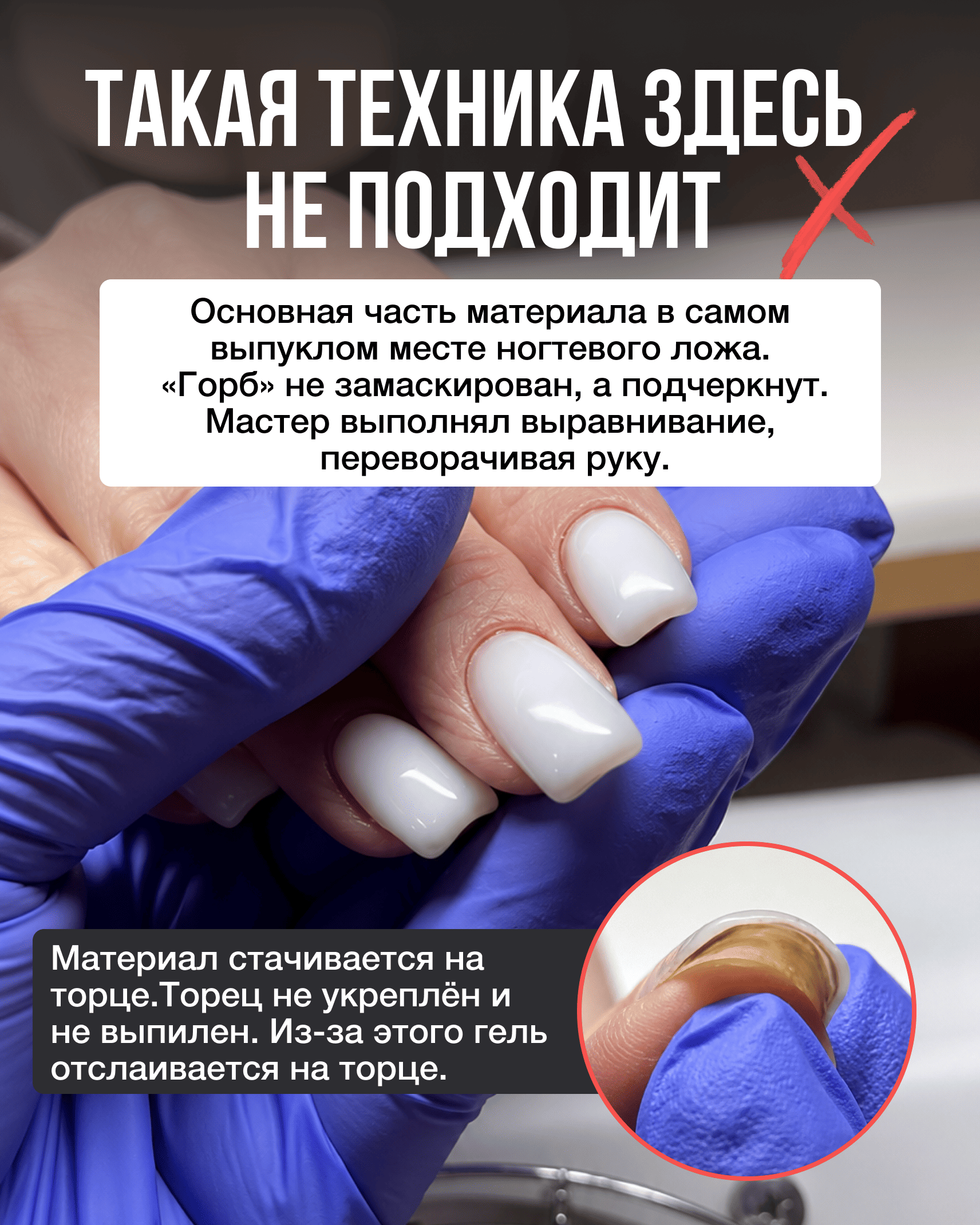 Неправильная техника выравнивания ногтей с перегрузкой ложа и отслойкой на торце